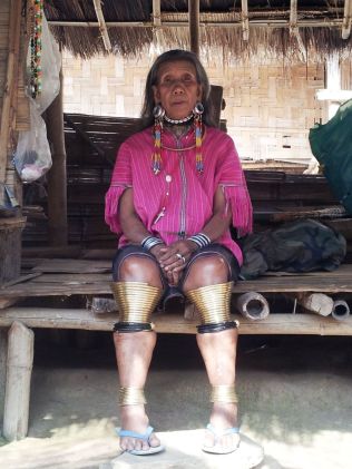 Thailandia-Donna-Hmong-con-caviglie-e-polpacci-deformati